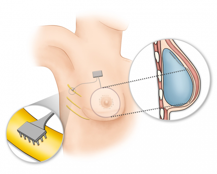 Schematic illustration of the Bionic Breast concept for a breast reconstructed using an implant.