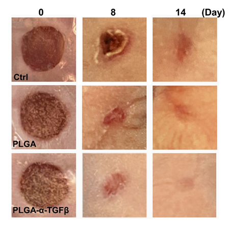 (​​​The wounds in skin grafts were treated with PLGA capsules with or without TGFβ inhibitor in HA-NB hydrogel, or alginate hydrogel as control at different time points.)